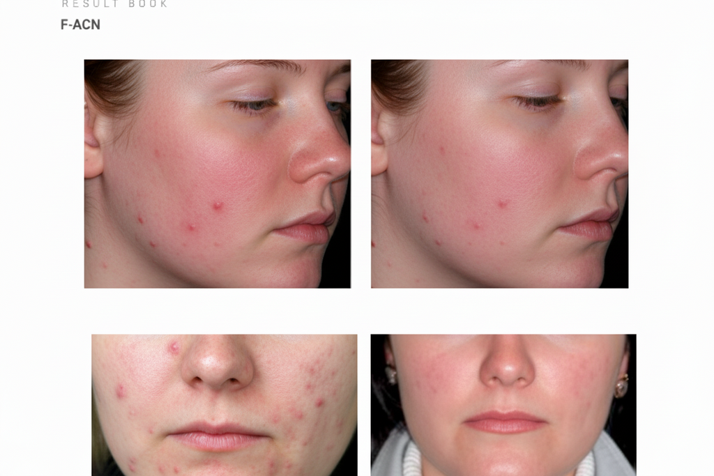 F-ACN - Acne & Oily Skin Ampoule  5 × 10 ml (50 ml)