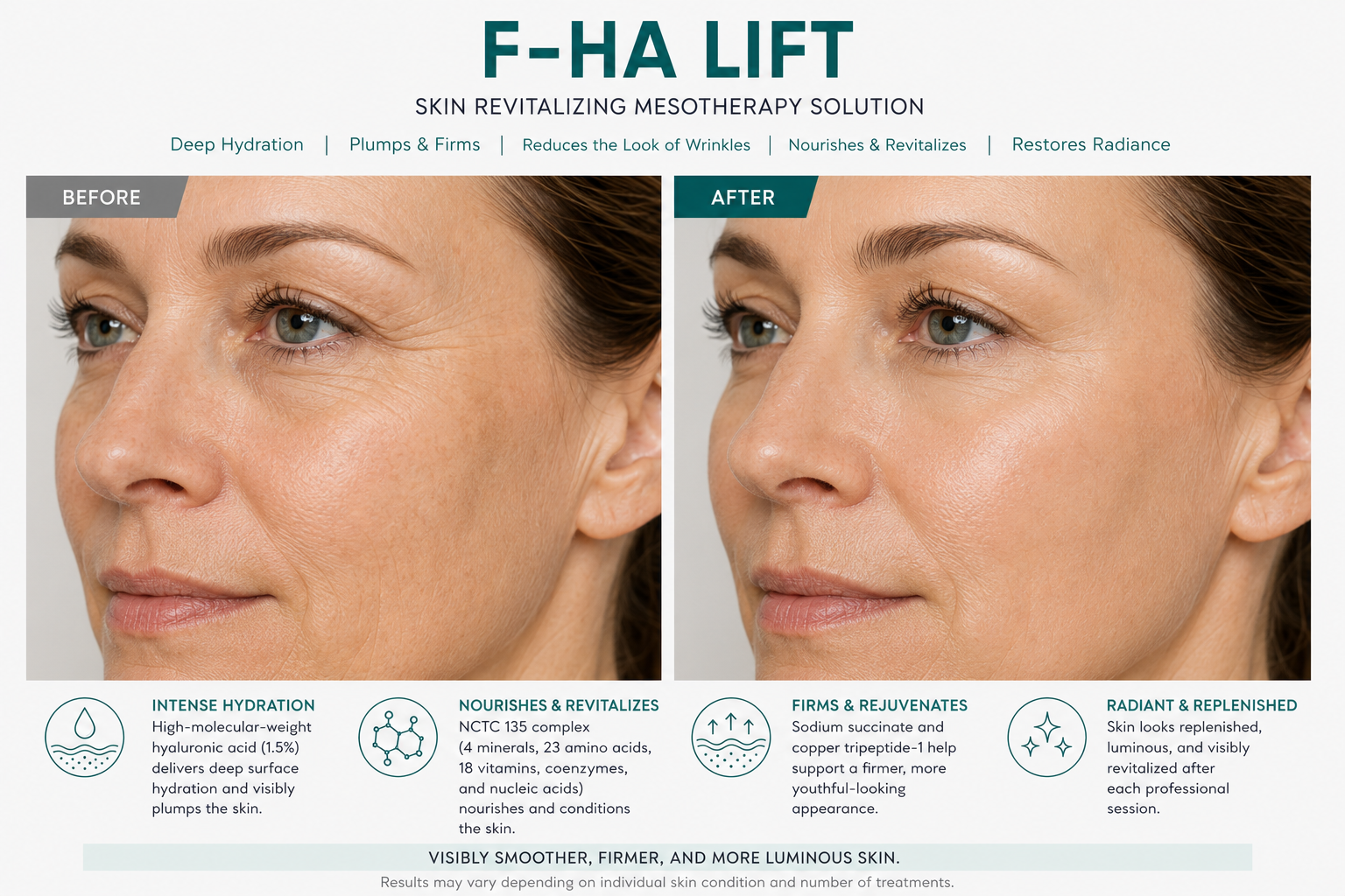 F-HA LIFT Hyaluronic Revitalizing Complex 5 vials x 5 ml (0.85 fl. oz)