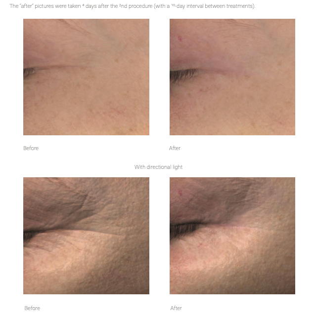 F-LIFT+ FACE Lifting & Firming Ampoule 5 × 5 ml (25 ml)