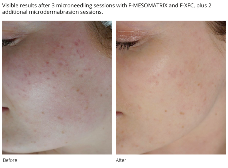 F-XFC   Cellular Revitalization Ampoule 5×10 ml (50 ml)