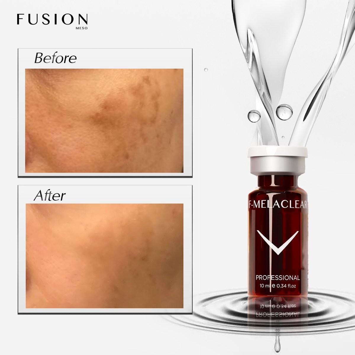 F-MELACLEAR Brightening & Dark Spot Ampoule 5 × 10 ml (50 ml)
